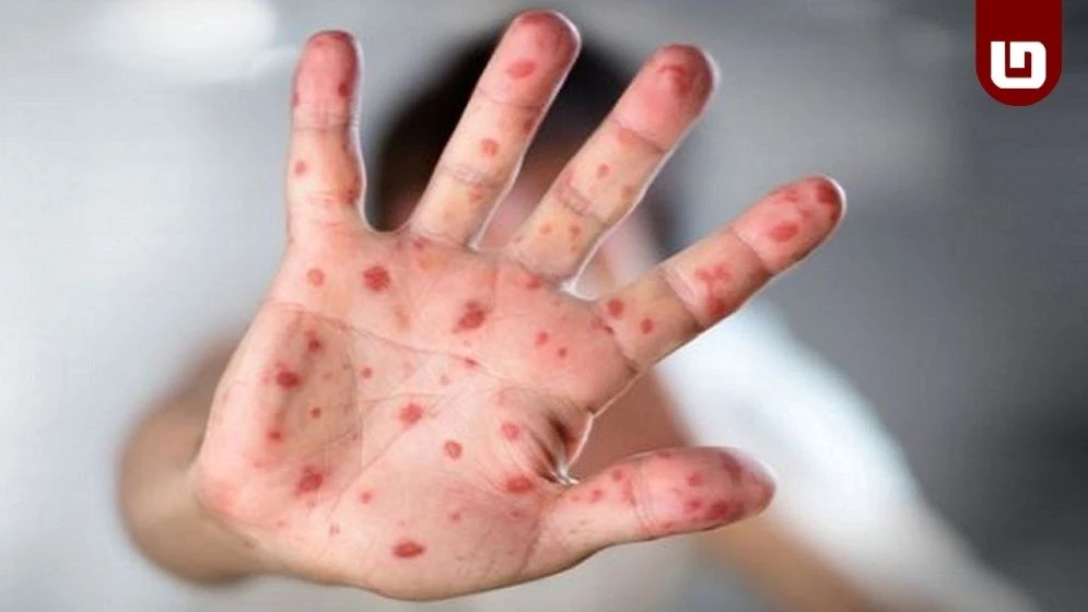 ২৪ ঘণ্টায় নতুন করে ৮২ জনের হাম শনাক্ত, হাসপাতালে ভর্তি ৭২৯ জন,৭ শিশুর মৃত্যু