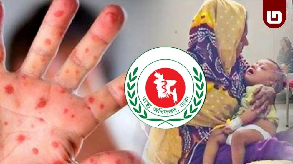 দেশে হামের প্রকোপ বাড়ছে, নতুন করে ১১ শিশুর মৃত্যু